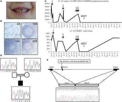 CD70 Deficiency due to a Novel Mutation in a Patient with Severe Chronic EBV Infection Presenting As a Periodic Fever